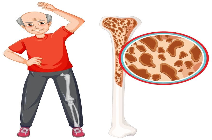 Aged men with osteoporosis