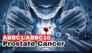 Docetaxel Response in Prostate Cancer
